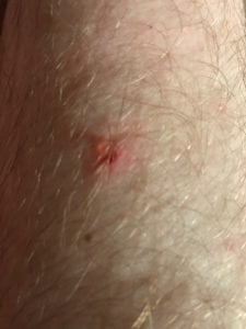 Initial tick bite treated with plantain healing balm
